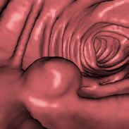 図2：仮想大腸内視鏡像（大腸ポリープ）