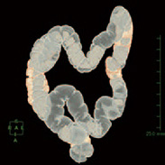 図3：注腸類似像