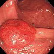 図4：大腸内視鏡像（大腸ポリープ）