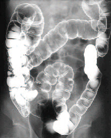 図5：注腸X線像